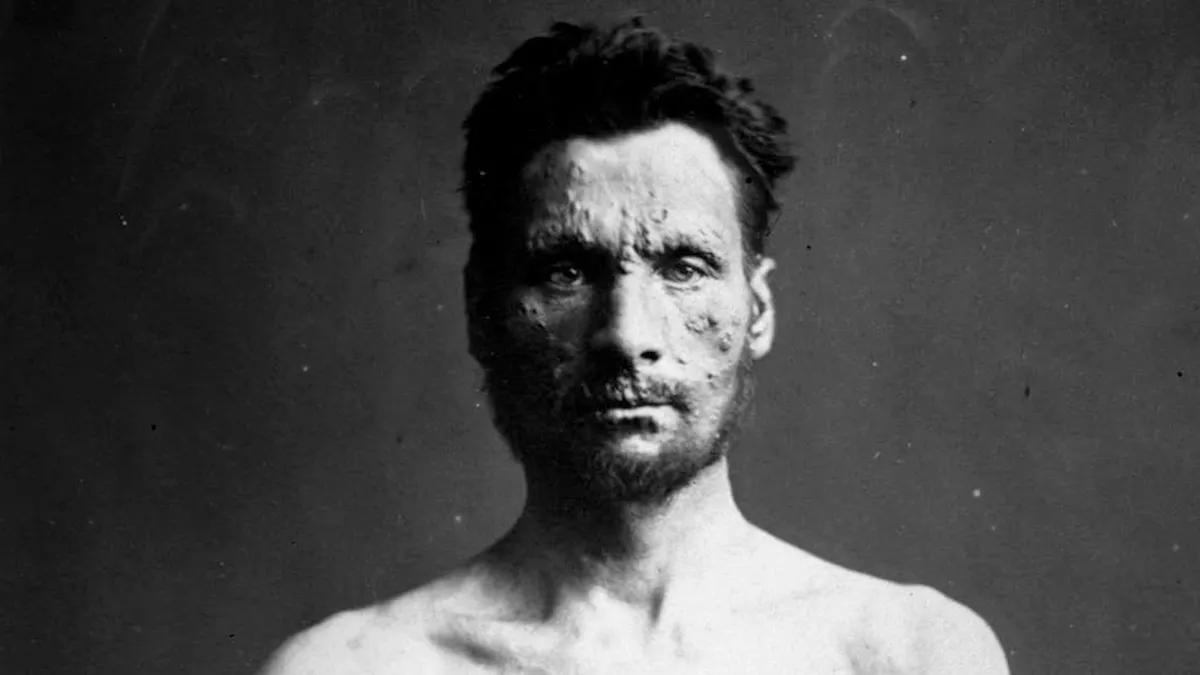 Spedalsk mann, avkledd. Oslo ca. 1900. Foto: Severin Worm-Petersen (Norsk teknisk museum) Individets eller folkets helse?